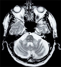 Diagnostic des hypersignaux de la substance blanche | Neurologie Pratique