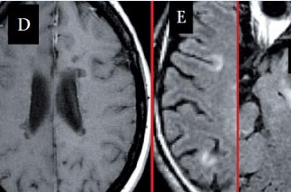 Sémiologie IRM de la SEP | Neurologie Pratique