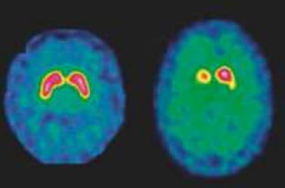 Scintigraphie cérébrale des syndromes extrapyramidaux | Neurologie ...