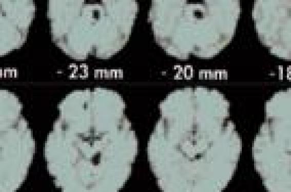 Physiopathologie de la migraine : quelles avancées ? | Neurologie ...