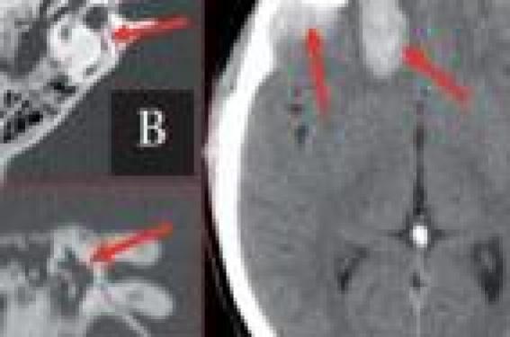 Vertiges : quand demander une imagerie ? | Neurologie Pratique