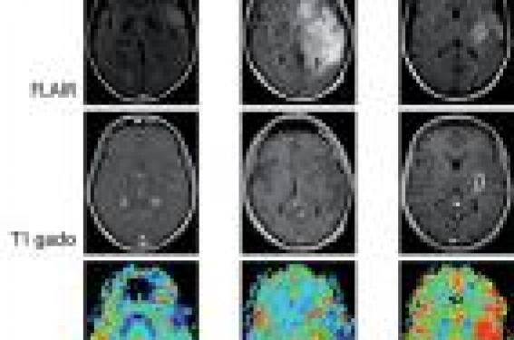 Les gliomes : diagnostic, classification, pronostic et traitement